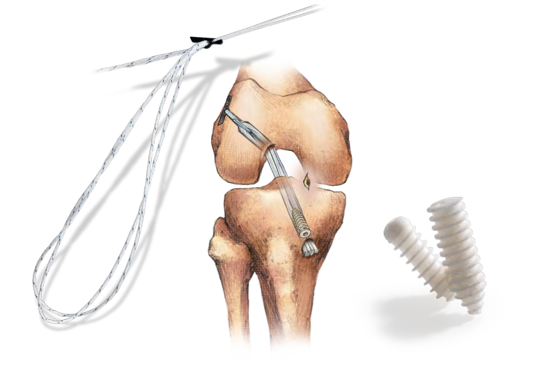 ACL reconstructie operatietechniek met tunnels en fixatie