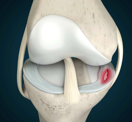 Anatomie van de meniscus