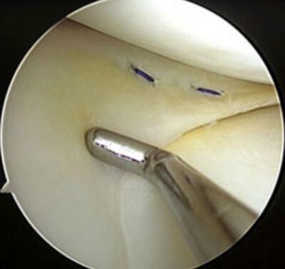 Meniscus behandeling en operatie
