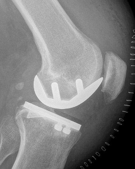 Unicondylaire knieprothese resultaat